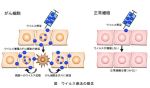 悪性胸膜中皮腫のウイルス療法を開始～抗がんウイルス G47Δを用いた初の胸腔内投与～