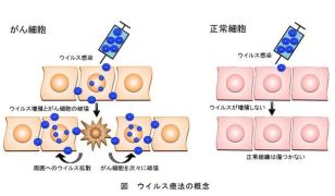 悪性胸膜中皮腫のウイルス療法を開始～抗がんウイルス G47Δを用いた初の胸腔内投与～