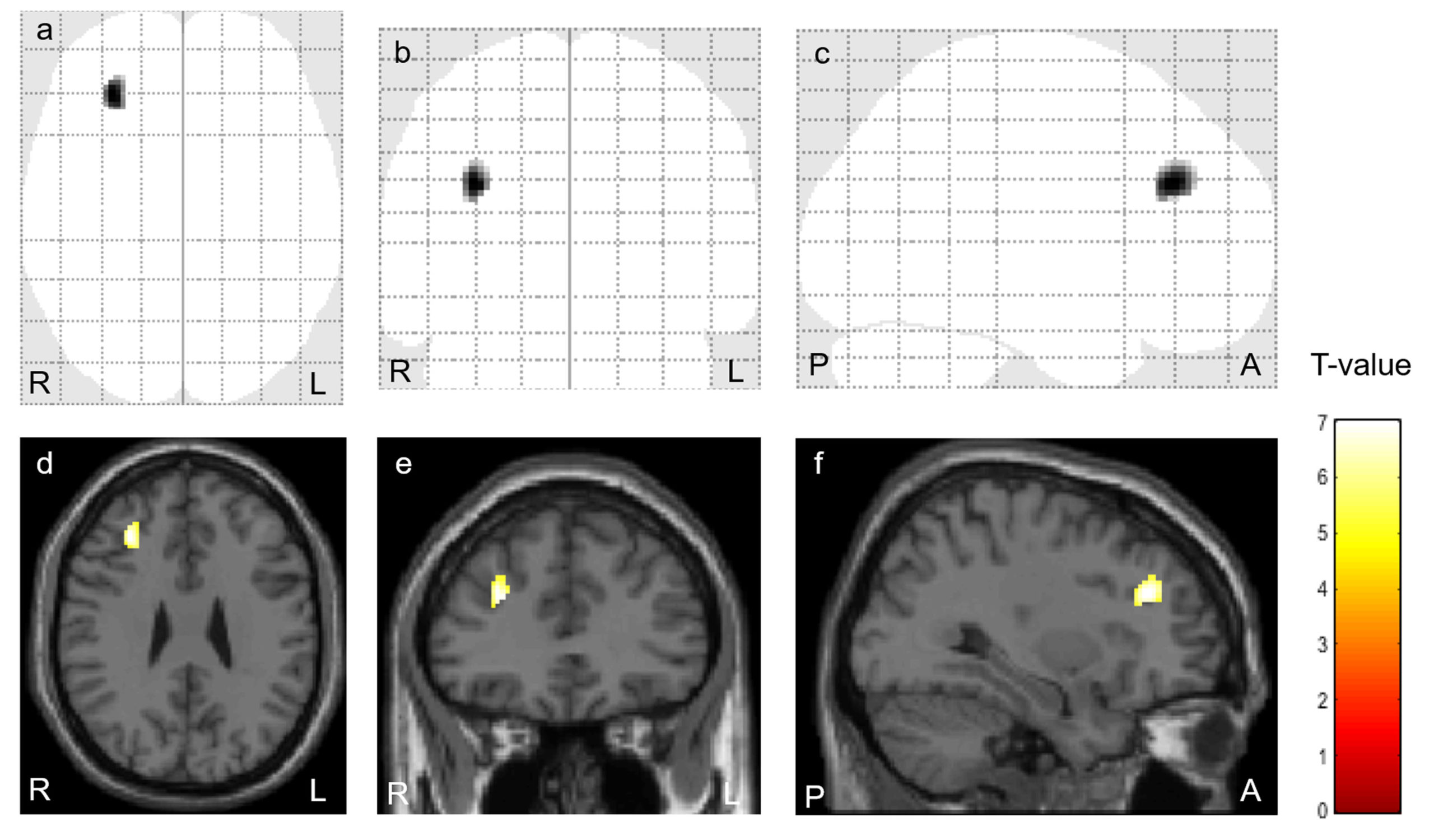 筋痛性脳脊髄炎 (ME/CFS)の自律神経受容体抗体に関連した 脳内構造ネットワーク異常を発見