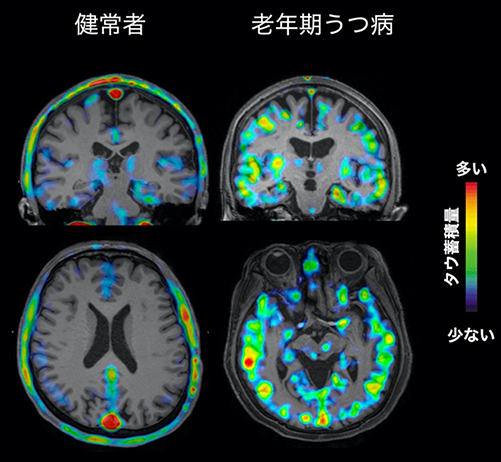 老年期うつ病を引き起こす可能性のある異常タンパク質を生体内で可視化