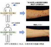 糖尿病の薬で皮膚の難病を発症するリスク因子を発見