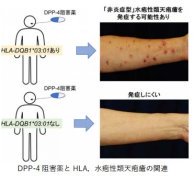 糖尿病の薬で皮膚の難病を発症するリスク因子を発見