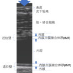 頚動脈プラーク進展はその後の循環器病発症リスクに関係する