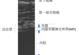 頚動脈プラーク進展はその後の循環器病発症リスクに関係する