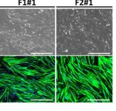 酸化ストレスが顔面肩甲上腕型筋ジストロフィーの原因遺伝子DUX4を増加させる