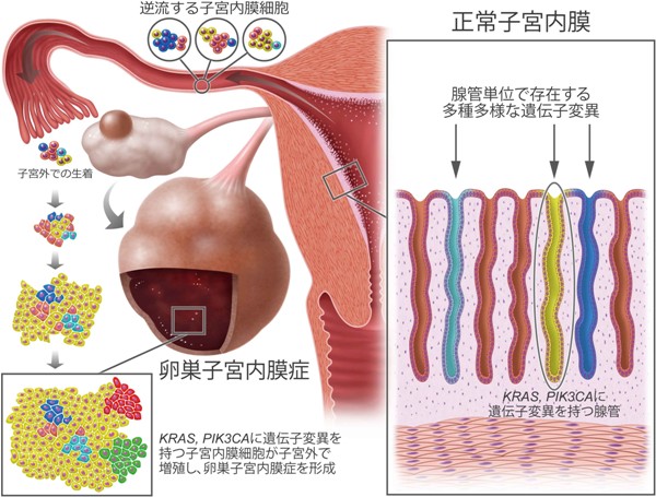 卵巣子宮内膜症および正常子宮内膜における遺伝子変異を解明