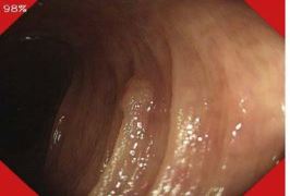 内視鏡検査で大腸ポリープ・癌を自動検知する人工知能（AI）を開発