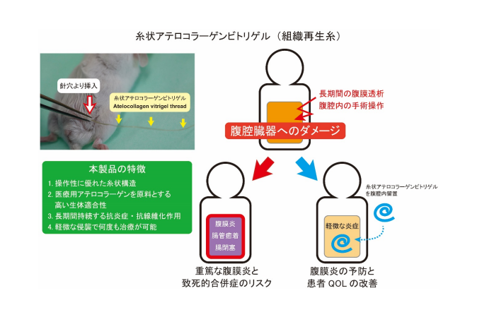コラーゲンの糸で腹膜炎と腸管の癒着を簡便に予防する方法を開発
