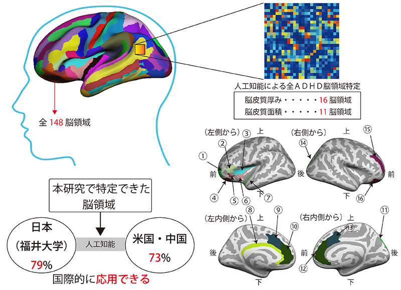 ADHDの脳構造の特徴を人工知能により解明し、遺伝子多型の影響を発見