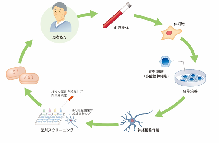筋萎縮性側索硬化症（ALS）に対するiPS細胞創薬に基づいた医師主導治験を開始