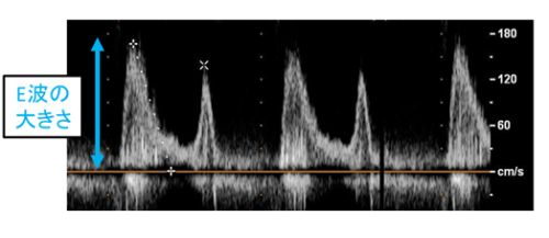 心エコー図検査による無症候性僧帽弁逆流症の簡便な予後予測指標を発見