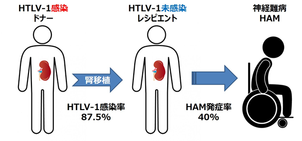 腎移植でHTLV-1ウイルスに感染すると、関連難病を発症するリスクが高いことが判明