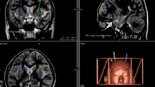 小児神経難病AADC欠損症に対する遺伝子治療で全例運動機能が改善 さらに認知機能の改善・治療の安全性も確認