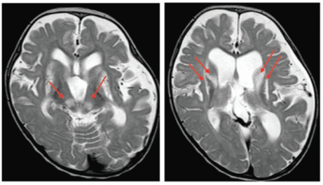 日本発・小児期Leigh脳症を起こす新しい病因遺伝子の発見