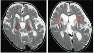 日本発・小児期Leigh脳症を起こす新しい病因遺伝子の発見