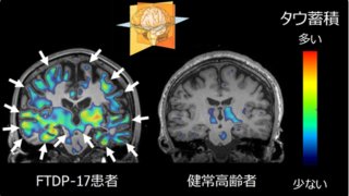 若年での発症例が多い遺伝性認知症で起こる脳内異常を解明