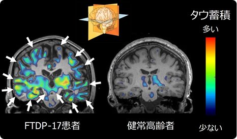 若年での発症例が多い遺伝性認知症で起こる脳内異常を解明