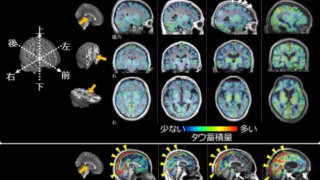 運動や認知機能が急速に低下する神経難病の原因を解明