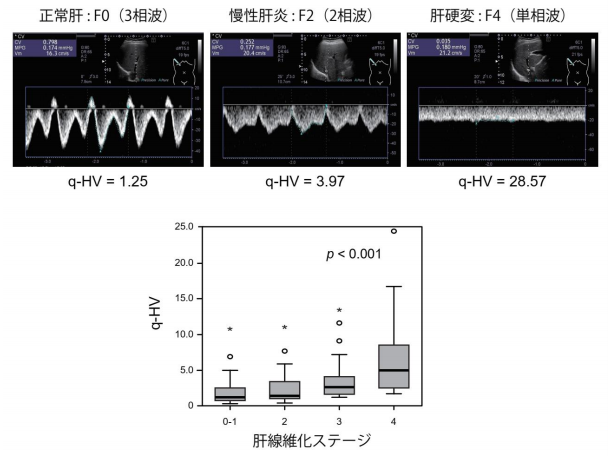 肝静脈血流の速度変化（肝静脈波形）を数値化した新しい肝線維化診断法の開発