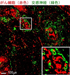 がんに自律神経が影響することを発見