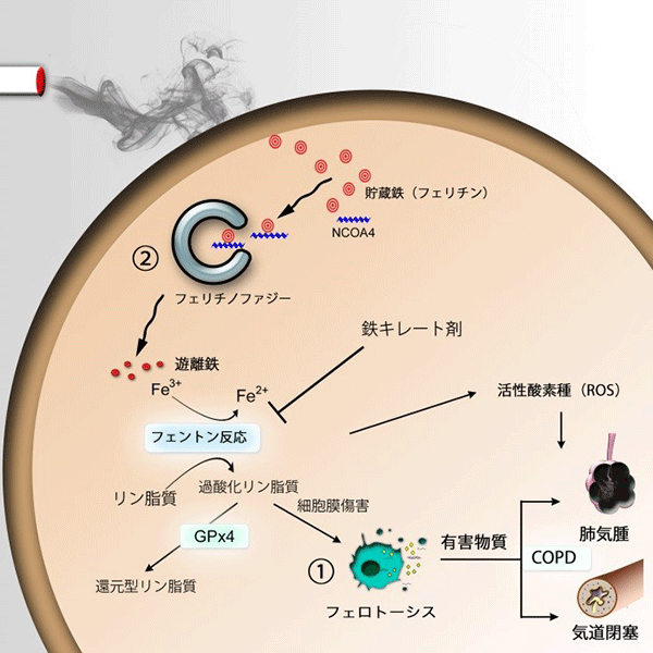 慢性閉塞性肺疾患：COPD（タバコ病）に、有害な鉄による脂質酸化依存的細胞死が深く関与…