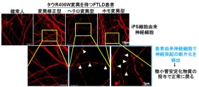 家族性認知症iPS細胞を樹立し、分化させた神経細胞から異常を検出