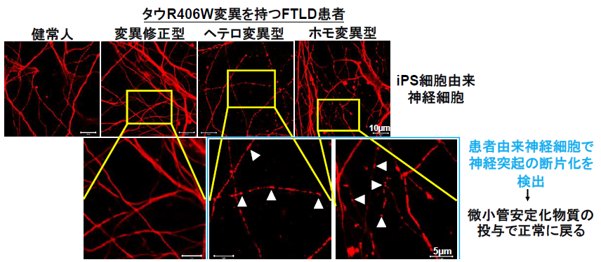 家族性認知症iPS細胞を樹立し、分化させた神経細胞から異常を検出