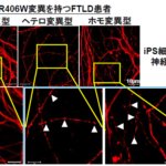 家族性認知症iPS細胞を樹立し、分化させた神経細胞から異常を検出