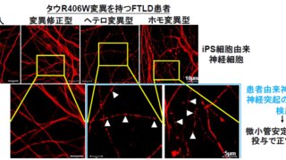 家族性認知症iPS細胞を樹立し、分化させた神経細胞から異常を検出