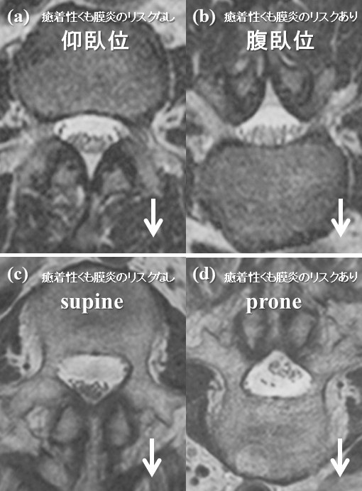 腰痛の原因になる腰部癒着性くも膜炎のMRIを用いた新しい診断アプローチ