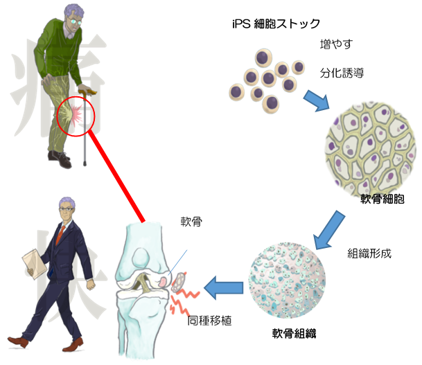 同種iPS細胞由来軟骨移植による関節軟骨損傷の再生について
