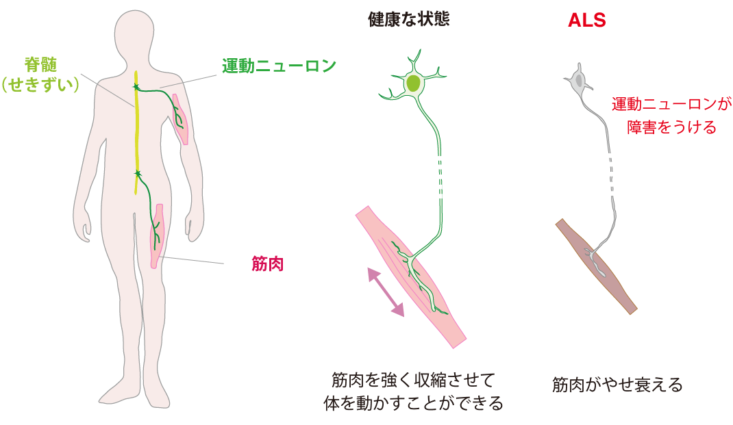難病 ALS、光操作で再現〜発病メカニズムの解明と創薬に期待〜