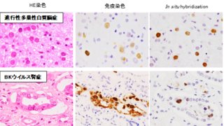 ウイルス由来マイクロRNAを標的とした感染症の新しい病理診断法の開発