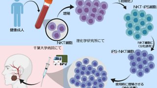 世界初、iPS-NKT細胞を血管内に直接投与～頭頸部がんの免疫細胞療法で治験を開始～