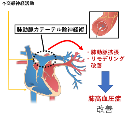 肺高血圧症の新しい治療である肺動脈カテーテル除神経治療の臨床試験を先進医療にて開始
