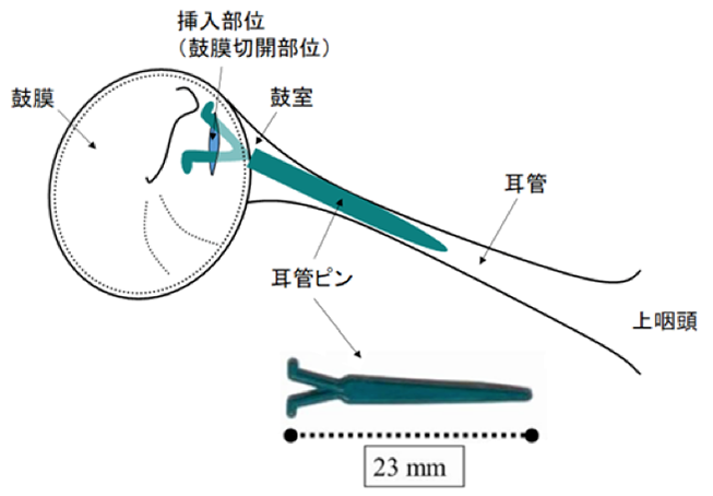 難治性耳管開放症患者に対する世界初の治療機器「耳管ピン」の承認取得