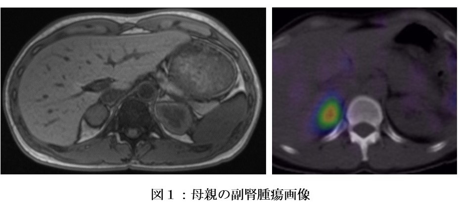 母体副腎腫瘍による胎児の男性化のメカニズムを解明