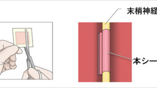 末梢神経に直接巻いて神経の再生を促進する新たなナノファイバーシートの治験を開始
