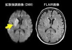 発症時刻不明脳梗塞患者への高度画像診断基準を用いた静注血栓溶解療法