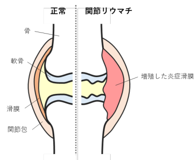 関節リウマチの遺伝素因と関連する新規治療標的を同定