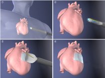 手術負担の少ない内視鏡による心臓表面への細胞シート移植デバイスを開発