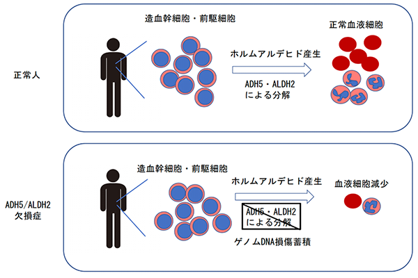新規の遺伝性再生不良性貧血症「ADH5/ALDH2 欠損症」を発見