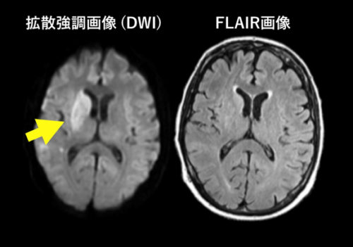 発症時刻不明脳梗塞患者への高度画像診断基準を用いた静注血栓溶解療法