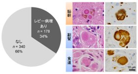 高齢者の1/3はパーキンソン病・レビー小体型認知症及びその予備群で、食道病変は重症度を反映する