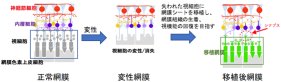 「網膜色素変性に対する同種（ヒト）iPS細胞由来網膜シート移植に関する臨床研究」の1例目の移植手術の実施について