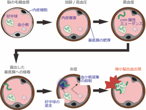 『悪玉むし歯菌』と『微小脳出血の出現』との関連を解明 脳卒中の機序の解明に寄与