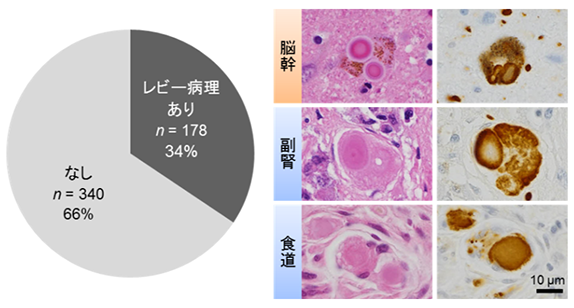 高齢者の1/3はパーキンソン病・レビー小体型認知症及びその予備群で、食道病変は重症度を反映する