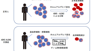 新規の遺伝性再生不良性貧血症「ADH5/ALDH2 欠損症」を発見