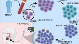 iPS-NKT細胞を活用したがん免疫細胞療法の治験1症例目が終了