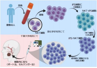 iPS-NKT細胞を活用したがん免疫細胞療法の治験1症例目が終了